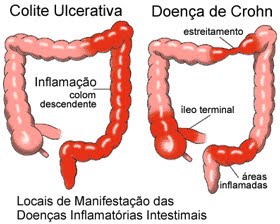 Doenças inflamatórias intestinais surgem da interação de quatro fatores fundamentais; entenda